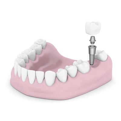 Image of a dental implant at Gordon Dental Associates