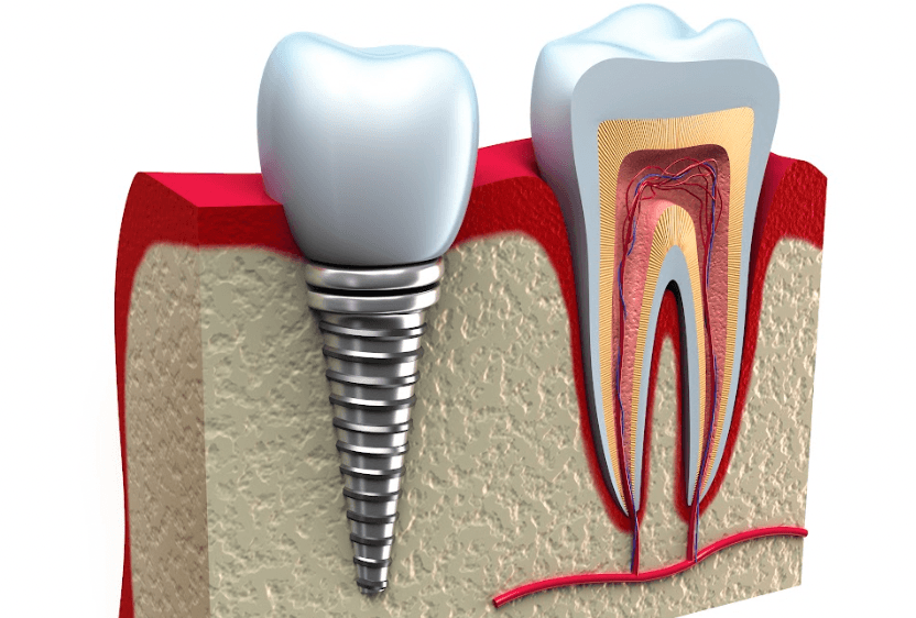 8 Warning Signs You May Need Dental Implants Dental Implants St