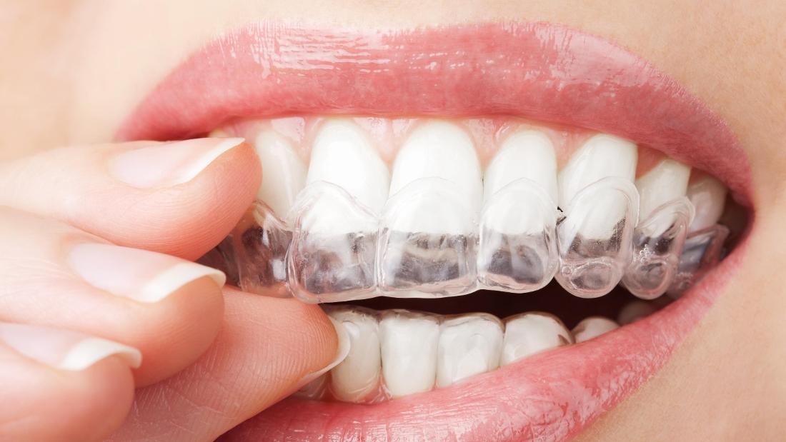 Gordon Dental Associates Blog How Does Invisalign Work?