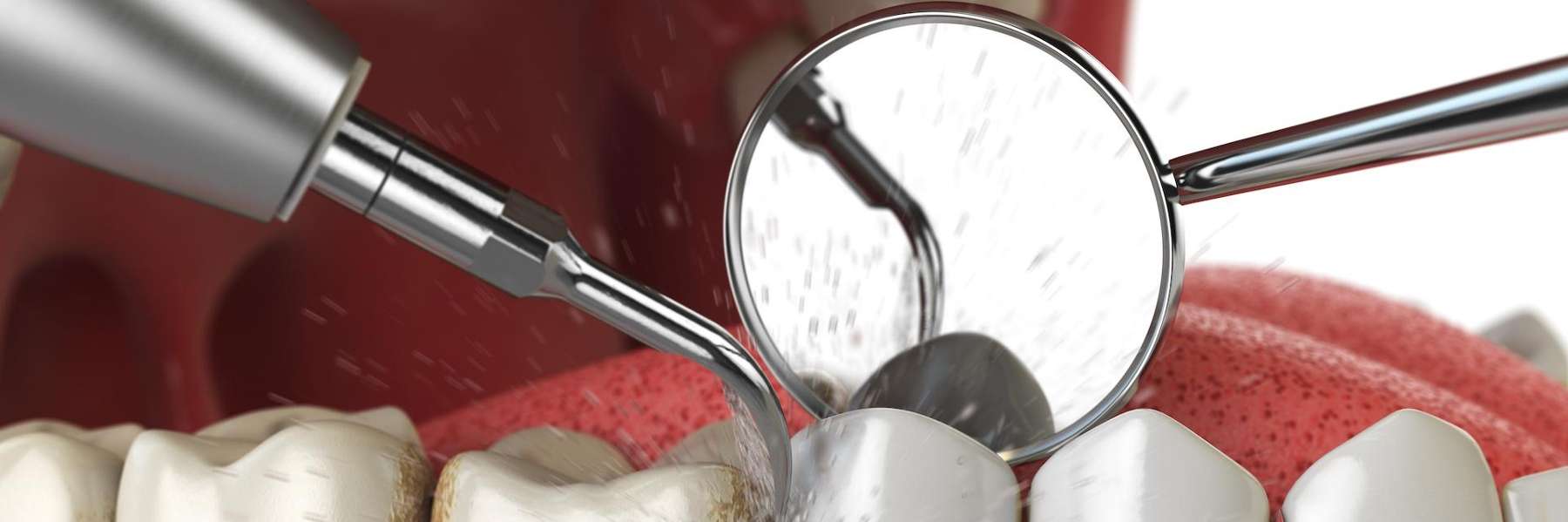 An illustration of a dental cleaning Services in St. Augustine, FL