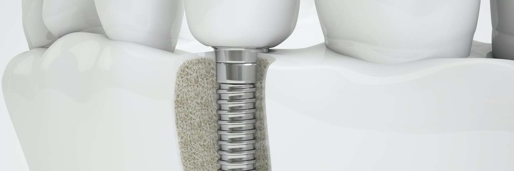 Illustration of a dental implant in St Augustine FL