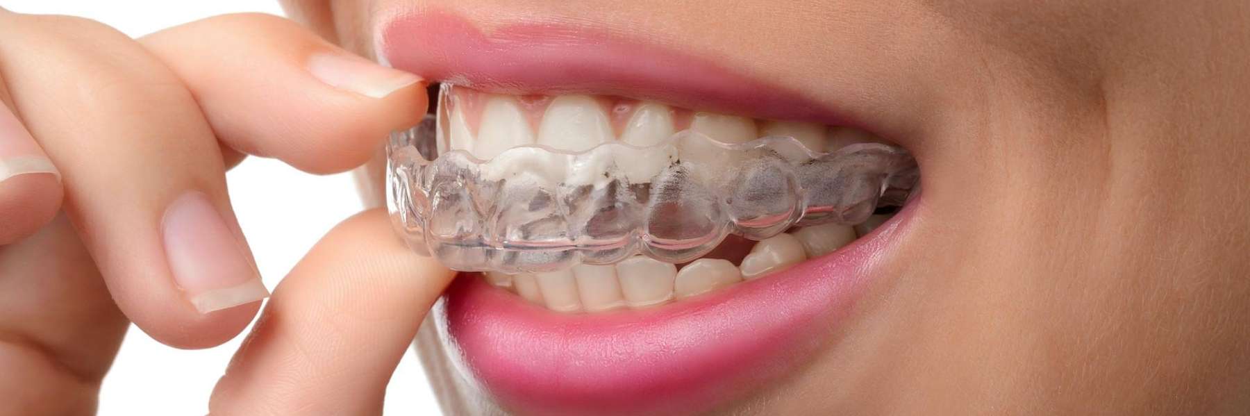 invisalign in St. Augustine, FL