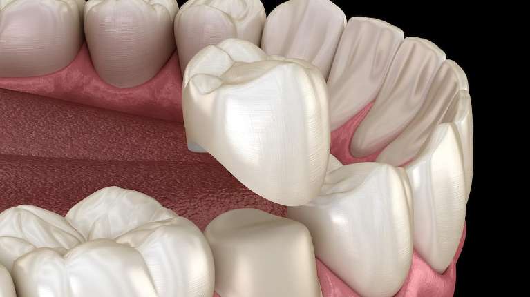 Diagram of a dental crown in st. augustine