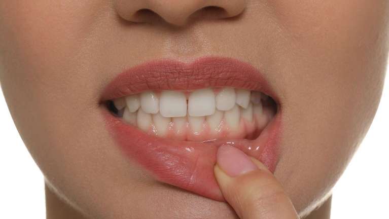 A woman showing her teeth | Gum disease st augustine