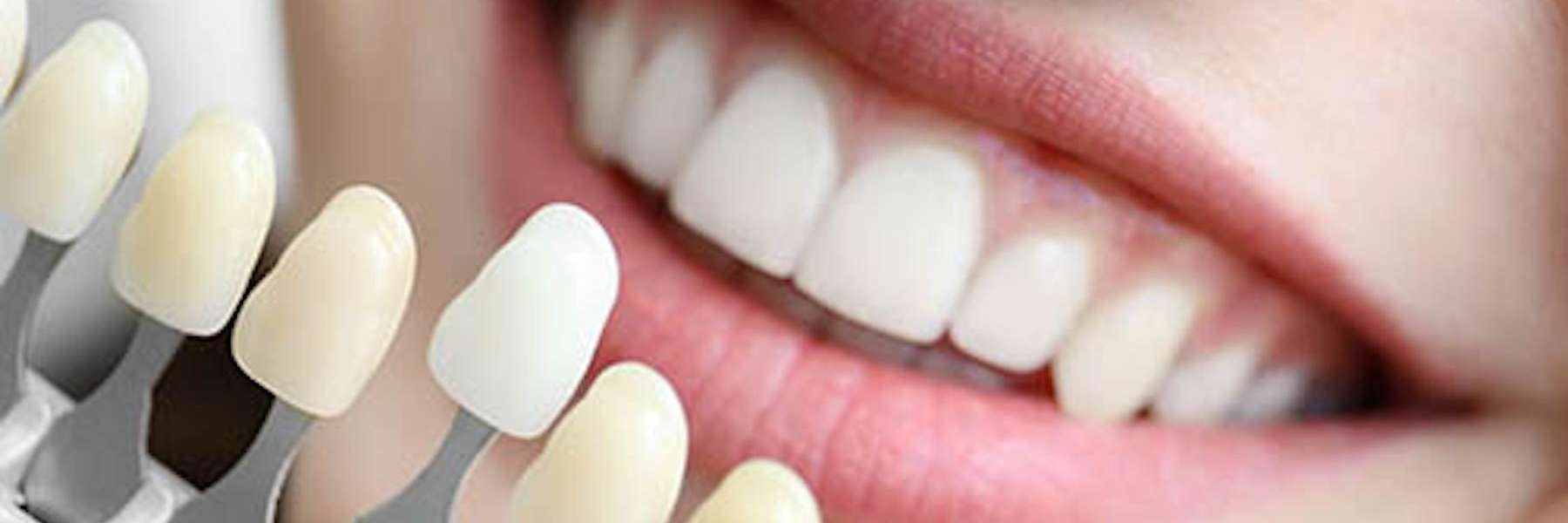 An image of some of the cosmetic dentistry treatment in St. Augustine, FL