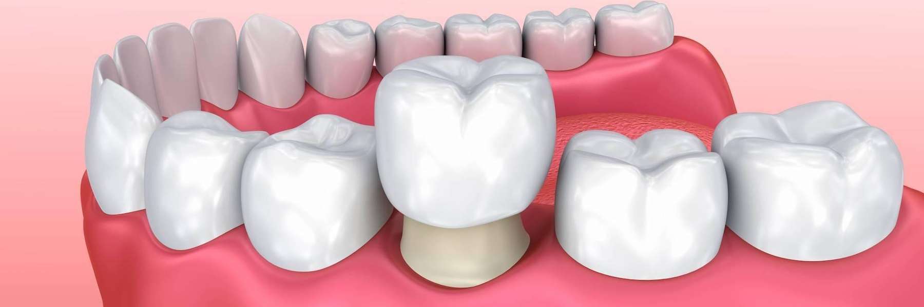 An illustration of a dental crown in st augustine, fl