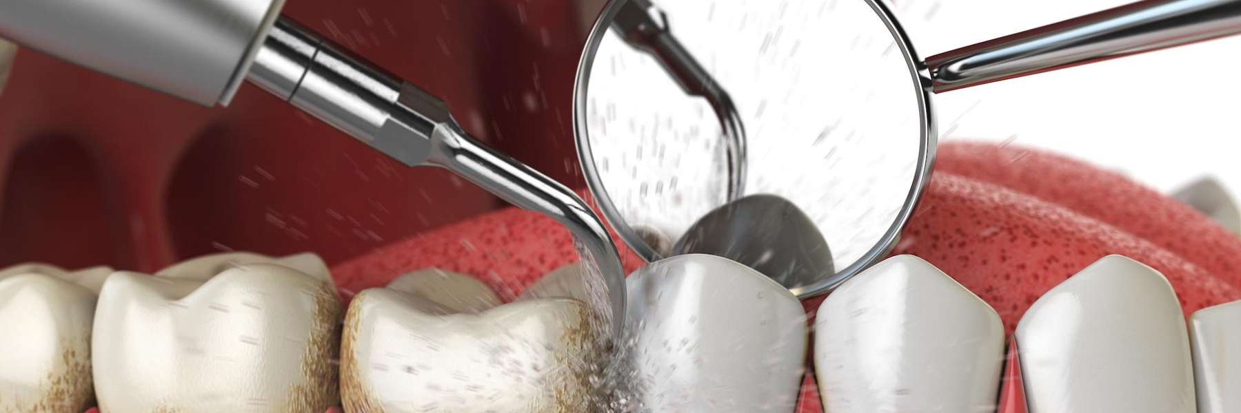 An illustration of a dental cleaning