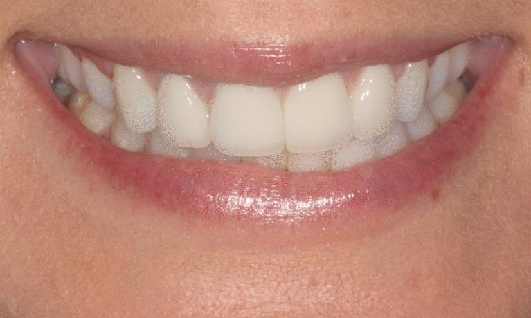 Four-front-veneers-to-brighten-smile-After-Image