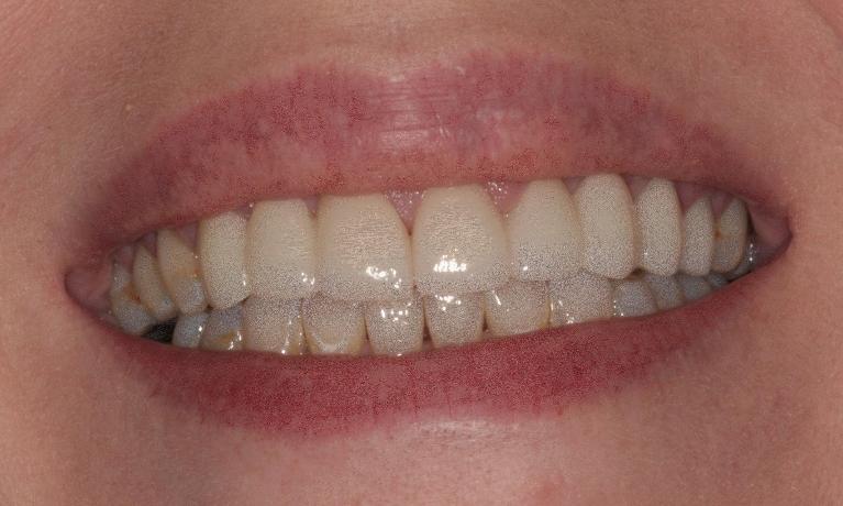 Smile-Make-over-After-Image