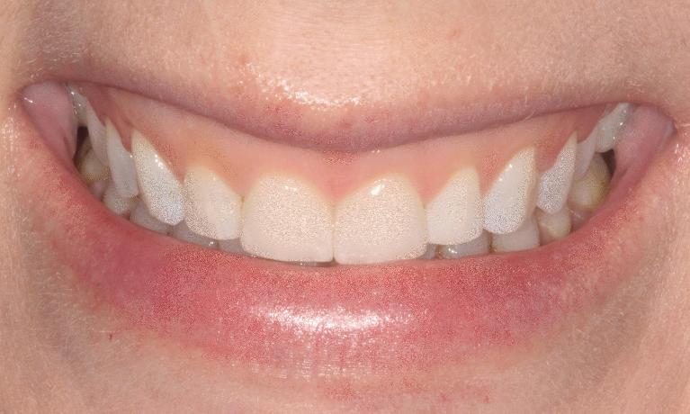 Veneers-to-create-a-brighter-smile-After-Image