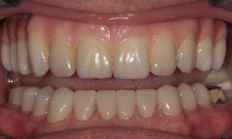Fixed-Implant-Dentures-help-a-patient-with-a-long-term-issue-of-breaking-teeth-After-Image