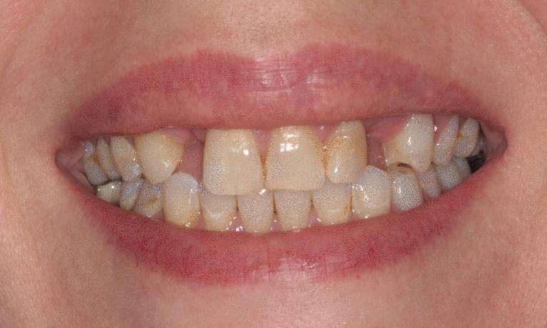 Smile-Make-over-Before-Image