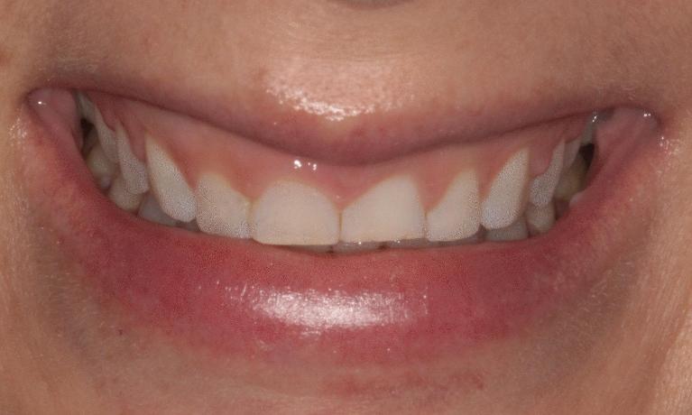 Veneers-to-create-a-brighter-smile-Before-Image