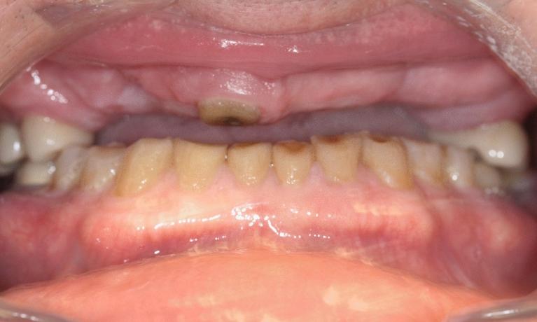 Fixed-Implant-Dentures-help-a-patient-with-a-long-term-issue-of-breaking-teeth-Before-Image