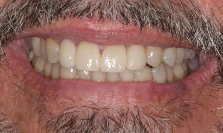 Four-Crowns-To-Create-A-Flawless-Smile-After-Image