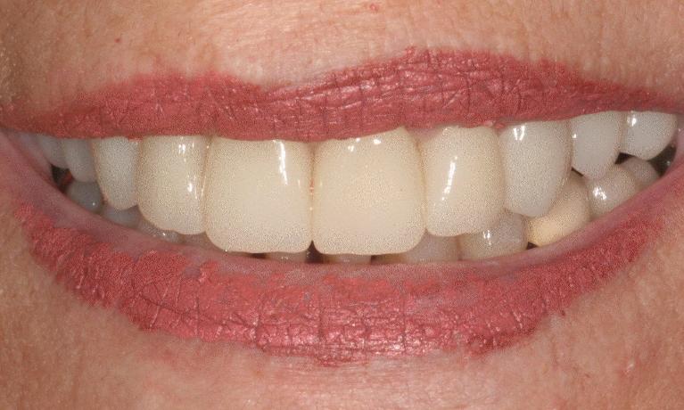 Full-Upper-Crowns-to-Achieve-the-Smile-She-Wants-After-Image