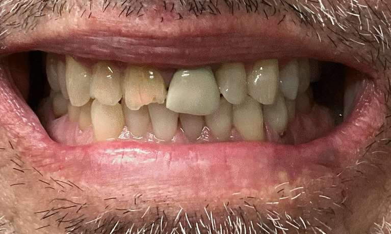 Four-Crowns-To-Create-A-Flawless-Smile-Before-Image
