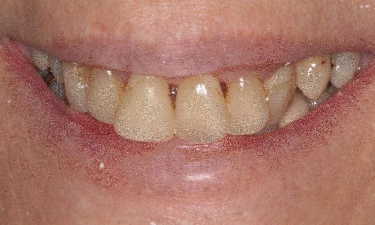 Full-Upper-Crowns-to-Achieve-the-Smile-She-Wants-Before-Image
